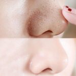 Blackhead Remover Nose Face Mask Strips x10 Black Head Pore Acne Clean - Image 4