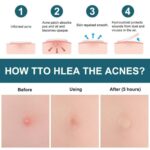 36/108pcs Skin Tag Remover Acne Pimple Patch Removal Facial Care Spot Plaster AU - Image 5