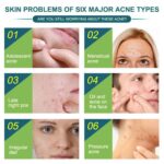 36/108pcs Skin Tag Remover Acne Pimple Patch Removal Facial Care Spot Plaster AU - Image 3