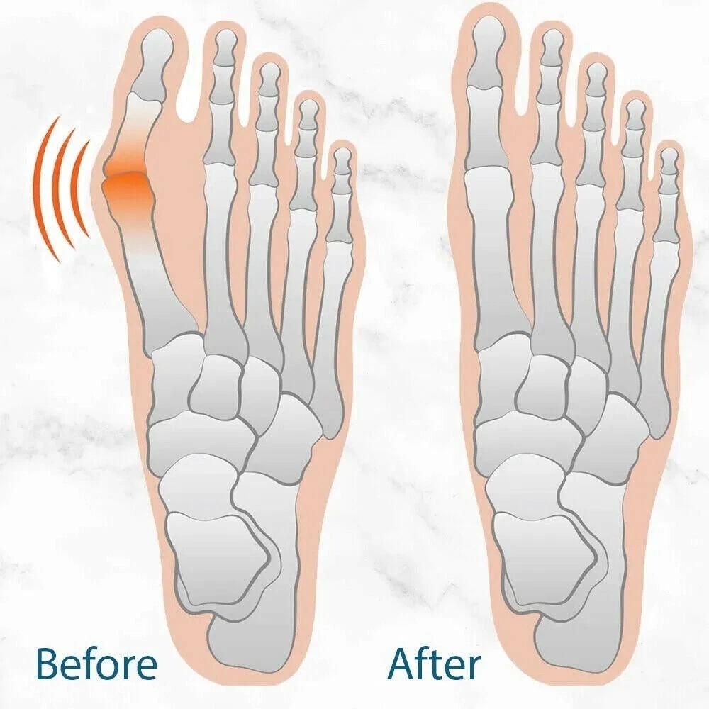 Thumb Valgus Corrector Cloth Foot Protector Thumb and Toe Valgus Foot Cover - Image 4